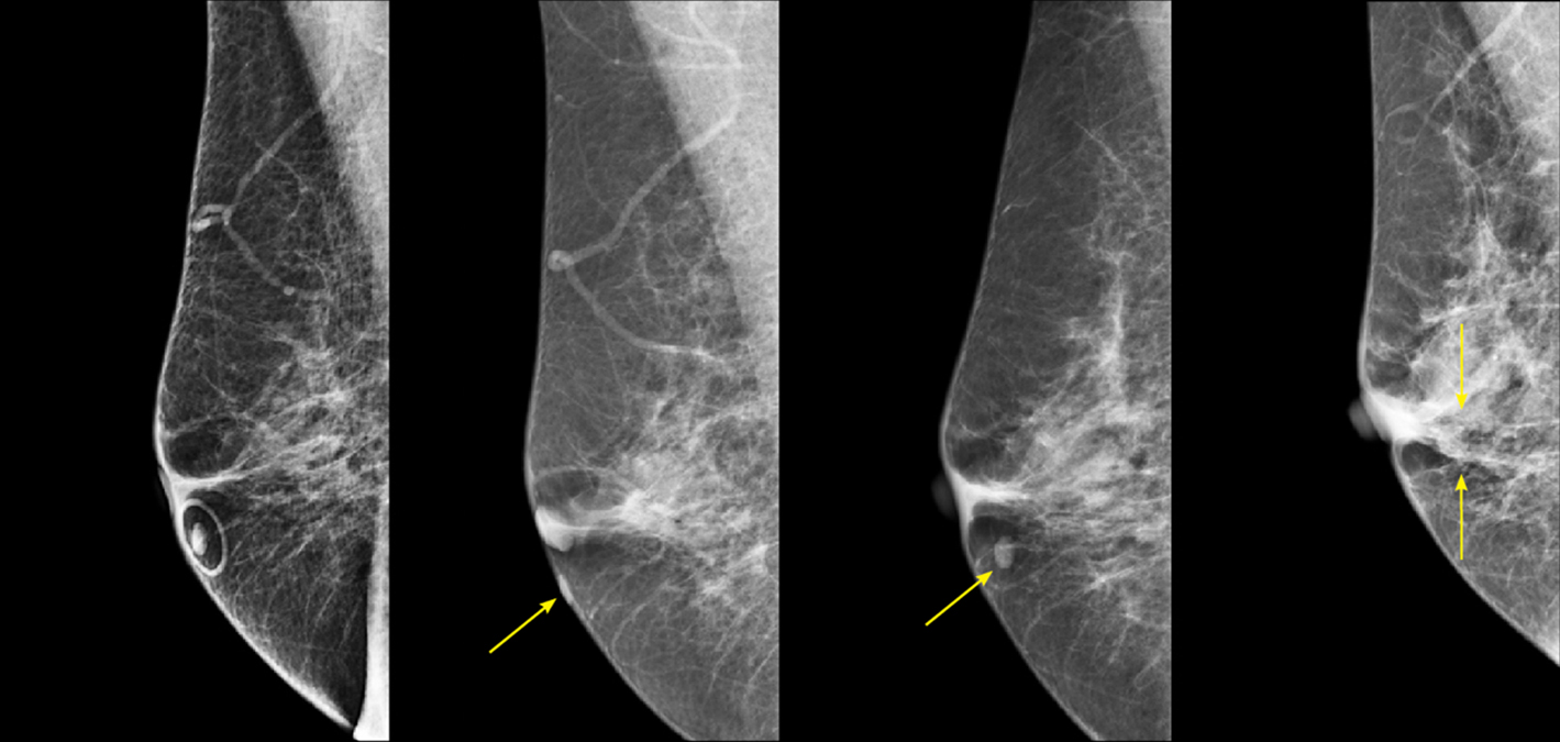 图1。R MLO从四个不同的年份的观点。在最左边的图像上，用圆形皮肤标记(TomoSPOT REF# 782, Beekley Medical)标记皮肤痣。这些图像显示，由于定位过程中皮肤的可动性，皮肤病变的位置可能存在显著的变化。