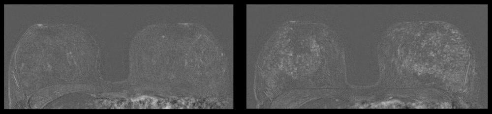 图1所示。左图为41岁未节育器患者的乳腺MRI。右图显示同一患者放置节育器27个月后实质增强。