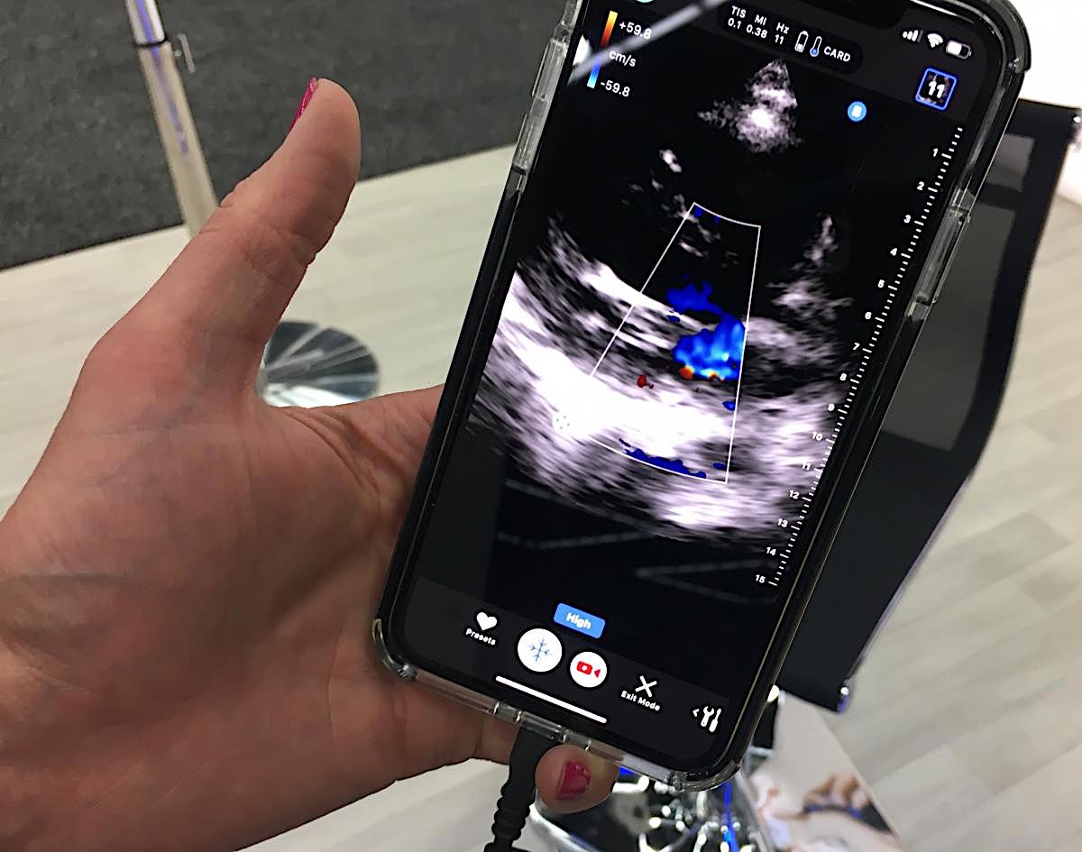 在2019年ASE会议上，一项对1000多名患者进行心脏超声检查的研究获得了积极的结果，这些患者使用了将智能手机转变为回声系统的Butterfly POCUS系统。