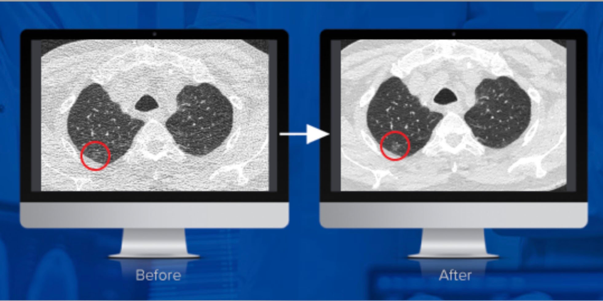 麻省总医院和弗吉尼亚大学的研究得出结论，algomeedica公司的一种颠覆性技术PixelShine显著提高了在降低辐射剂量下获得的CT扫描的诊断质量。在这里，您可以看到应用降噪之前和之后。