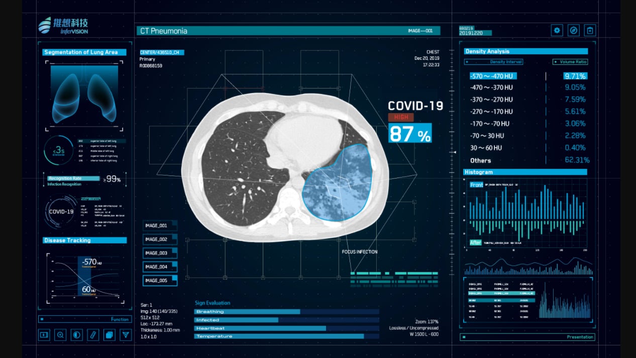 人工智能供应商Infervision的InferRead CT肺炎软件使用人工智能辅助诊断来提高放射科的整体效率。作为新型冠状病毒肺炎(COVID-19)的高灵敏度检测手段，它在中国被推迟。#COVID19 #冠状病毒#2019-nCoV