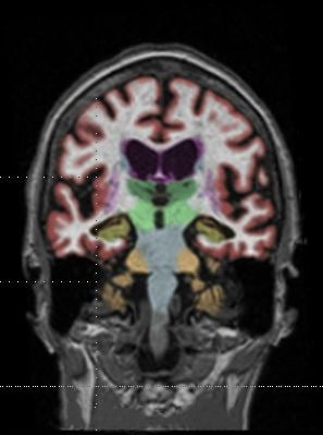 钆基造影剂在脑MRI中的应用
