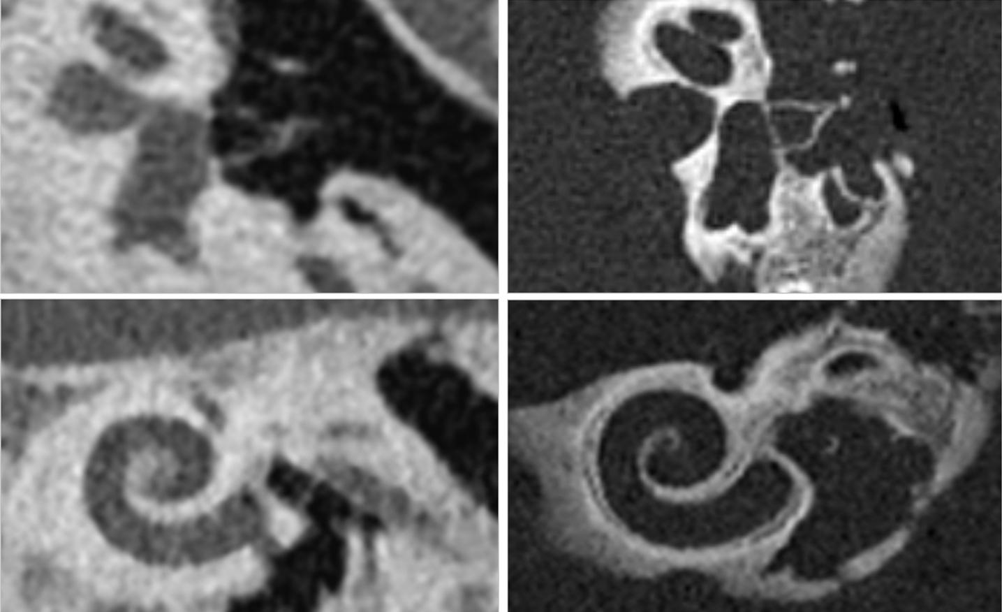 光子计数CT增强了中耳和内耳的可视化。耳蜗中耳和内耳的微小解剖结构，如镫骨(上排)和耳蜗(下排)左侧图像采用常规CT成像，右侧图像采用照相计数CT成像。图片由瑞典林雪平大学A. Persson博士提供。