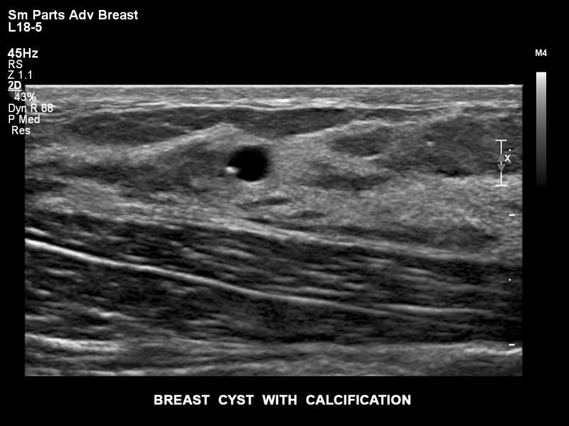 乳腺囊肿和钙化的飞利浦Epiq超声图像。乳腺超声常用于乳腺组织致密的妇女的乳房x光造影增强。