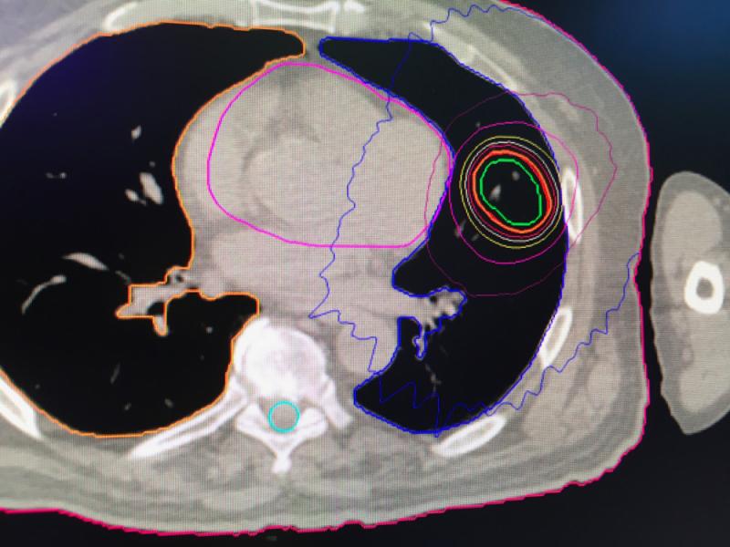 使用新的Synchrony for Radixact，运动跟踪和校正技术的肺癌肿瘤放射治疗的运动跟踪示例。# astro19 # astro2019 # astro