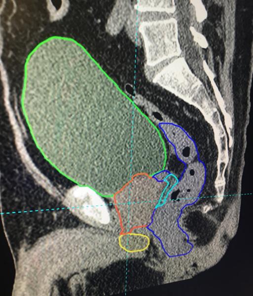 这是一个人工智能被用于Mirada DLCExpert软件自动识别和轮廓化放射治疗的解剖结构的例子。这个例子显示的是注射的OAR空间水凝胶(蓝色部分)在前列腺和直肠之间创造空间，以防止辐射敏感结构的损伤。这种凝胶在CT扫描中很难识别，因为它看起来像直肠或前列腺的一部分。但该软件经过训练，可以在它出现时识别出来。