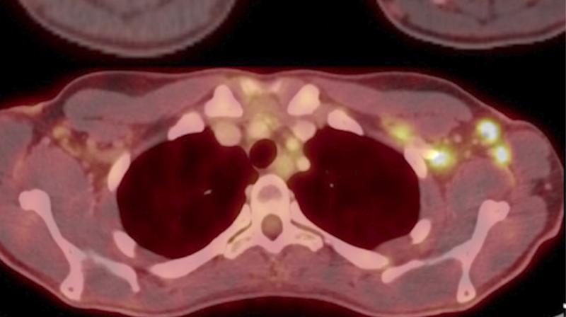 32岁女性癌症患者18-FDG PET/CT腋窝水平轴向融合图像显示由于COVID-19疫苗导致多个新的高代谢淋巴结。阅读原文。图片由RSNA提供。