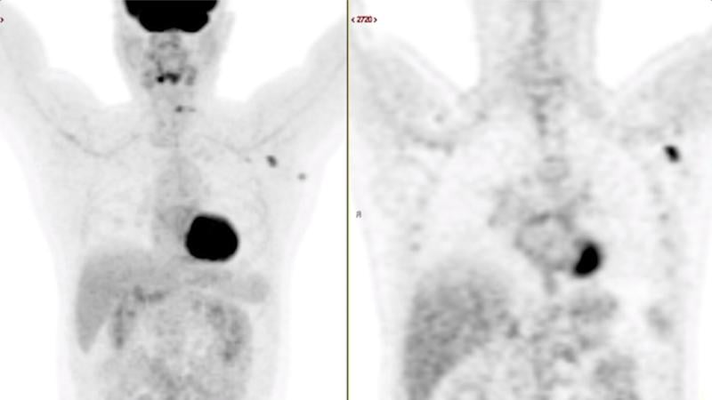 一名63岁的多发性骨髓瘤患者，在第二次接种COVID-19 mRNA后62天(9周)出现新的FDG PET-CT贪婪腋窝淋巴结病，伴有骨骼疼痛。淋巴结摄取是典型的接种疫苗的患者，腺病发生在接种疫苗的手臂一侧。一例由COVID-19疫苗引起的腋窝腺病。图片由RSNA提供。