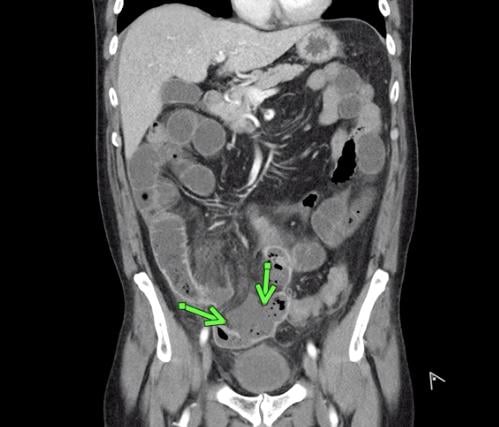 肠系膜上动脉血栓形成并发肠缺血和穿孔，54岁男性，因腹痛就诊于急诊室，被诊断为COVID-19。腹部和骨盆CT增强图像显示小肠粘膜强化(绿色箭头)。