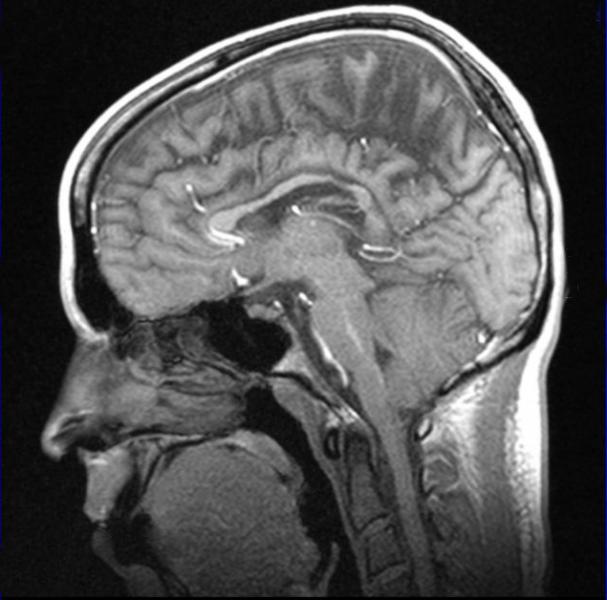 磁共振成像中使用的钆造影剂(gbca)会导致钆滞留在大脑中，可能会造成患者安全问题。杰夫Zagoudis