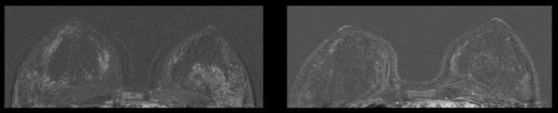 图2。左图显示45岁的宫内节育器患者。右图为取下节育器32个月后同一患者的乳腺MRI。