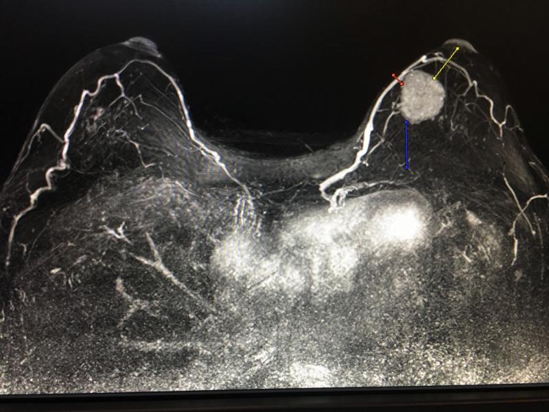 本周，在2019年HIMSS大会上，富士胶片的Synapse 3D放射学软件发布了五款新的高级可视化应用程序。这些图像来自一种新的磁共振成像(MRI)乳腺分析软件。彩色动力学曲线阈值视图显示了钆造影剂的冲洗和冲洗，以确定肿瘤是良性还是癌症。