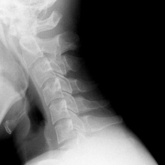 使用DDR，临床医生可以可视化脊柱或关节，如肩膀，在运动中。(未显示)DDR还可用于可视化肺呼吸和横膈膜漂移，如呼吸过程中横膈膜、肺和胸壁的运动。
