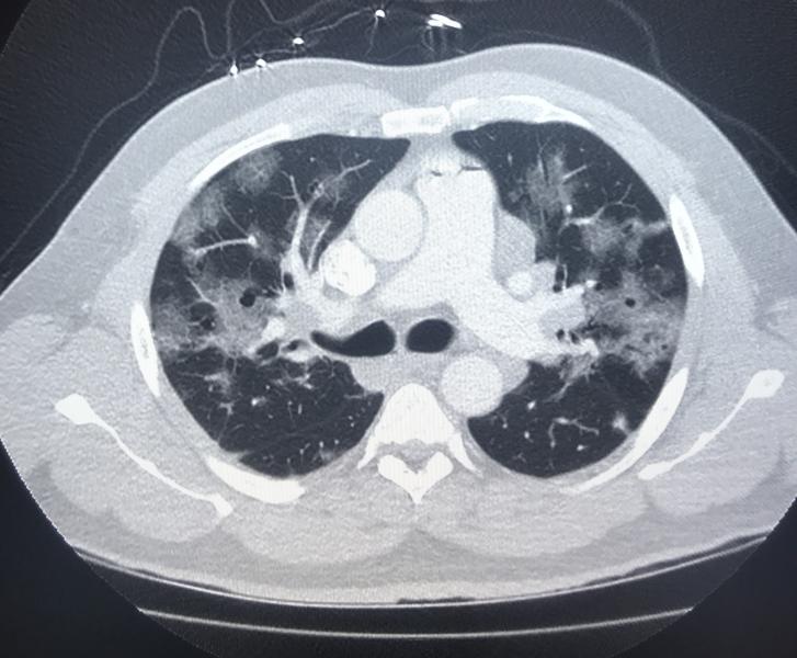 An American COVID-19 positive patient computed tomography (CT) lung scan showing ground glass lesions caused bu coronavirus pneumonia. Image from radiologist John Kim. Rea the related article a href=//www.alohadebbie.com/content/ct-provides-best-diagnosis-novel-coronavirus-covid-19
