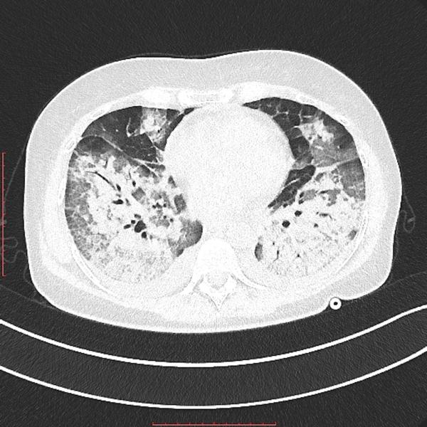 as肺CT横切面显示肺部重区冠状病毒肺炎。心形在图像的中央。盖蒂图片社