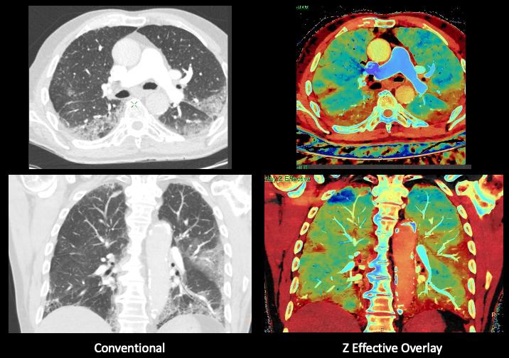 老年患者入院，其症状与COVID-19一致。由于病人有干咳和呼吸短促，要求做CT。图像在Philips IQon光谱CT扫描仪上完成。页面左侧显示常规CT，同一切片上显示Z有效光谱成像，显示了新冠肺炎的区域，包括在常规CT上不明显的区域。