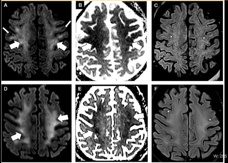图1来自Radiology文章。2例精神状态持续抑郁的COVID-19危重症患者的脑MRI，包括一名56岁的男性(a - c)和一名64岁的男性(D-F)。两例患者半卵形椎体水平轴向弥散加权(A, D)、表观弥散系数(B, E)和FLAIR像(C, F)均表现为对称弥散T2/FLAIR高强度(箭头)和轻度弥散受限(厚箭头)，累及深部和皮层下白质