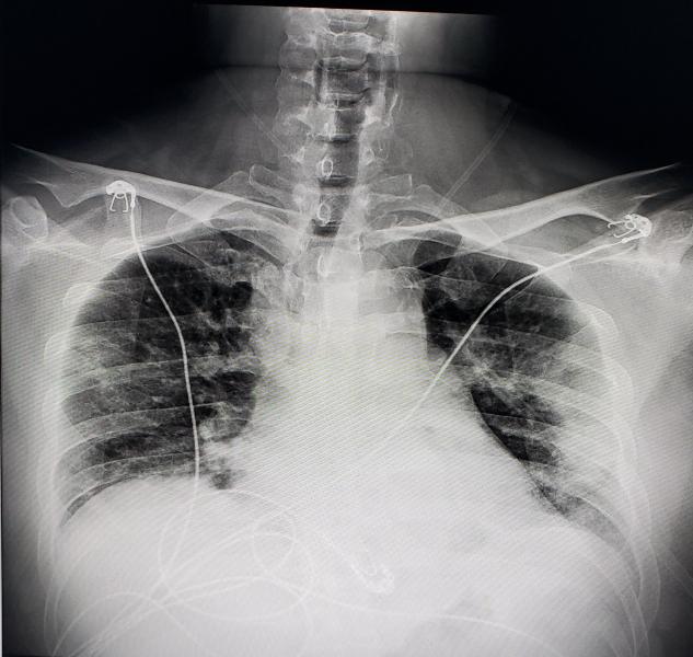 来自德克萨斯州的一名COVID-19患者的数字x光胸片显示，COVID-19肺炎沿胸壁两侧。 Photo from radiologist John Kim, M.D.