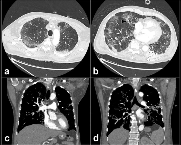 COVID-19导致一些患者血液凝结，这可能导致肺栓塞，如图所示，摘自《放射学》杂志。阅读更多关于这种COVID并发症的信息，并找到关于这些图像的更多信息。