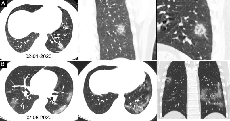 胸部CT显示，34岁男性，发烧4天。2020年2月8日，拭子标本反转录聚合酶链反应检测严重急性呼吸综合征冠状病毒2型阳性。检查日期显示在图像上。一个, Chest CT scan with magnification of lesions in coronal and sagittal planes shows a nodule with reversed halo sign in left lower lobe (box) at the early stage of the pneumonia. B, Chest CT scans in different axial planes
