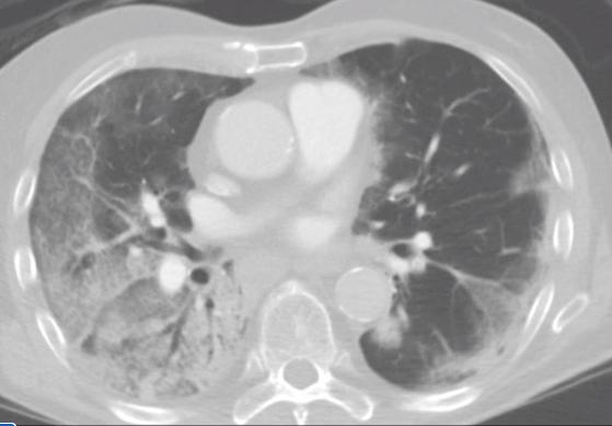 计算机断层扫描(CT)显示肺部的COVID-19肺炎，典型的COVID位置可见磨砂玻璃不透明(GGOs)，附着在肺壁的下部。通过视频查看整个CT数据集。图片由Margarita Revzin等人提供。