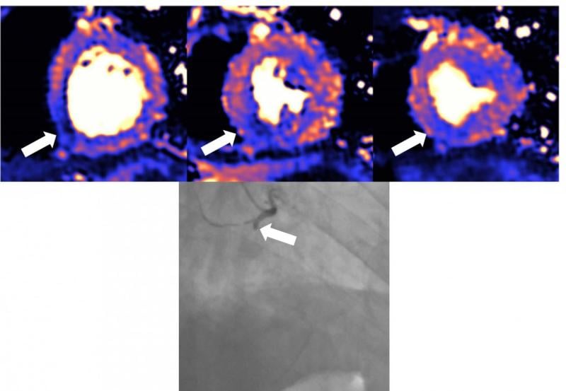 新冠病毒可导致心肌炎、梗死和/或缺血，心脏受损的MRI扫描。蓝色代表血液流动减少，橙色代表血液流动良好。图中心脏下部呈深蓝色，因此心肌血流量大大减少。血管造影显示为心脏这部分供血的冠状动脉被阻塞了。这三张彩色MRI图像显示了心脏的不同切片——基底中部切片和顶部切片。阅读更多。图片来自《欧洲心脏杂志》