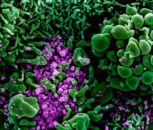 这张由扫描电子显微镜拍摄的彩色增强图像显示，大量的SARS-CoV-2颗粒(紫色)从肾细胞(绿色)中爆发出来，病毒劫持了这些细胞进行复制。右上角和左下角凸起的球形细胞变形了，即将从里面的病毒粒子中爆发出来，并开始自我毁灭。图片来自NIAID综合研究设施。