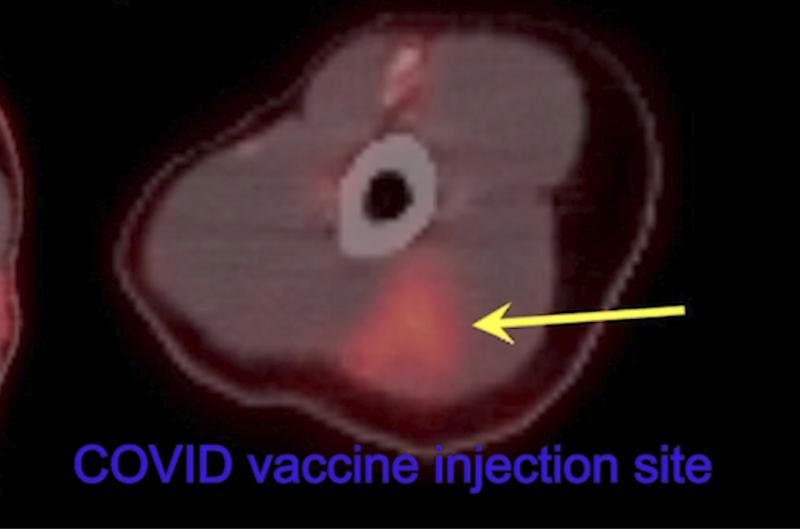 32岁女性，左臂18-FDG PET/CT显示新冠疫苗注射部位高代谢性三角形炎症(箭头)。阅读原文。图片由RSNA提供。
