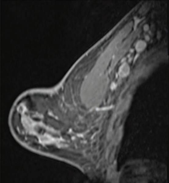 COVID-19疫苗已被发现会导致腺病、腺组织或淋巴结炎症，这可能在筛查性乳房x光检查中显示为一个问题。这张照片显示的是一名41岁妇女，她在第一次接种COVID-19疫苗15天后接受了高危乳腺MRI筛查。矢状位t1加权脂肪饱和增强MRI显示广泛的左侧I-II级腋窝腺病。分配BI-RADS 3。