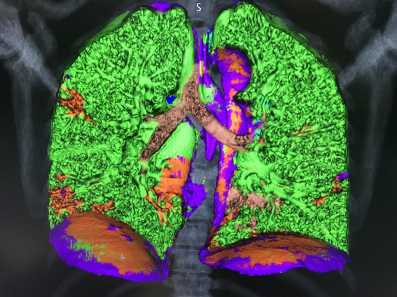 这是佳能最新先进的可视化肺分析工具上的一名COVID-19患者的肺。它使用CT Hounsfield单元测量的组织密度和组织纹理来标记和量化COVID肺炎实变区域。它在FDA紧急使用授权下获得了批准，并在2021年HIMSS会议上展示。绿色区域为正常肺，红色区域为新冠肺炎。该软件可以自动量化这些区域，作为评估长途运输的基线。