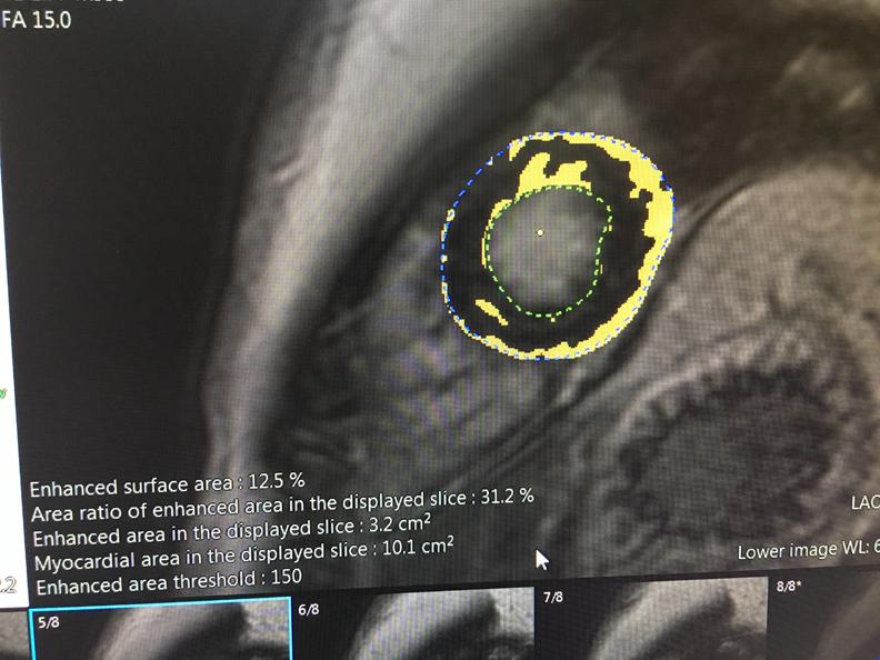 这是富士胶片本周在HIMSS 2019大会上发布的新的心脏MRI分析软件的一个样本。