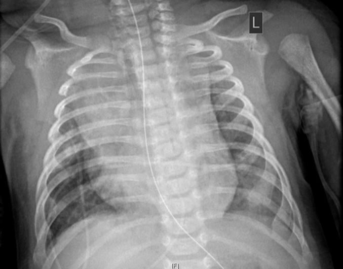 新冠肺炎导致心力衰竭的小儿患者胸部x光片。确诊为COVID-19的2个月大婴儿的胸部x光片显示心脏增大，肺下半部分塌陷导致双颅底混浊，以及右上叶肺不张(肺塌陷)。