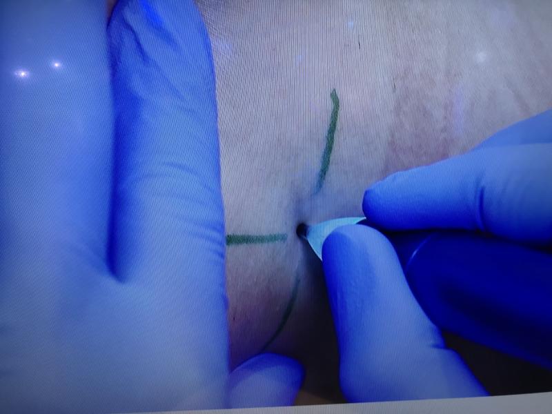 这是一种新的纹身标记，可以用来标记放射治疗患者的皮肤目标。这些标记在整个治疗过程中被用于使CT和放疗系统在每次治疗和后续扫描期间与肿瘤和治疗计划保持一致。Civco精准医疗系统使用一次性墨水和无菌包装的针头，如果用户不是一个有经验的纹身师，使用起来非常方便。这是Civco在2021年ASTRO上展示的新产品。#阿斯特罗