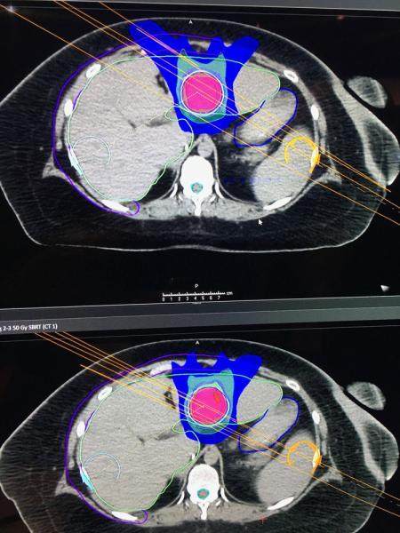 这是Raysearch在今天的ASTRO 2019会议上展示的机器学习和人类创建的胰腺癌放射治疗方案的比较。该供应商获得了FDA对这种机器学习技术和MRI和CT自动分割的批准。# astro19 # astro2019 # astro