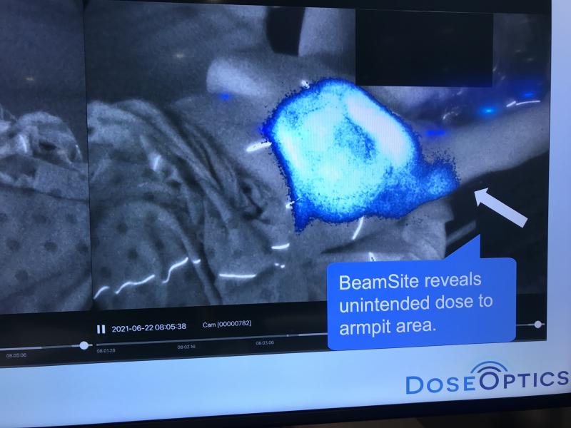 DoseOptic在2020年获得了FDA的许可，其切伦科夫辐射成像系统可用于放射治疗过程中，因此可以可视化辐照场。该系统可以显示出光束不对准的区域，或健康组织不必要的照射。他们在2021年ASTRO上展示了全乳腺放射治疗的例子，光束的边缘击中了患者的下巴和手臂。一段视频展示了病人如何移动，他们把手臂放在治疗区域。# ASTRO21 #阿斯特罗