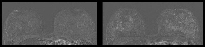 左图为41岁未节育器患者的乳腺MRI。右图显示同一患者放置节育器27个月后实质增强。图片由RSNA提供