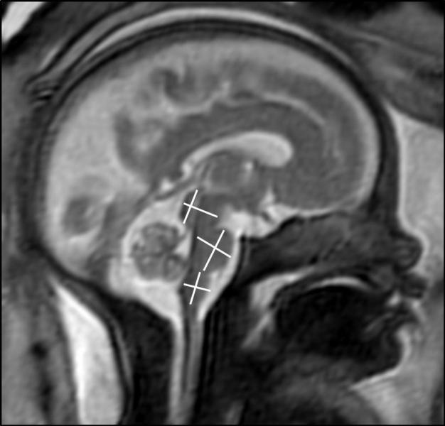 这张图像显示的是胎儿大脑发育的核磁共振成像。图片由RSNA提供