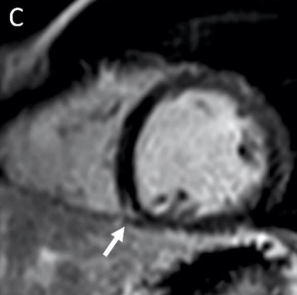 19岁男性右心室附件(箭头)MRI显示晚期钆强化(LGE)。图片由RSNA提供