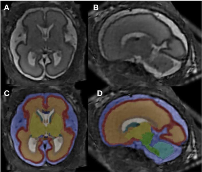 MRI超分辨率重建与基于atlas的组织分割。图片由RSNA提供