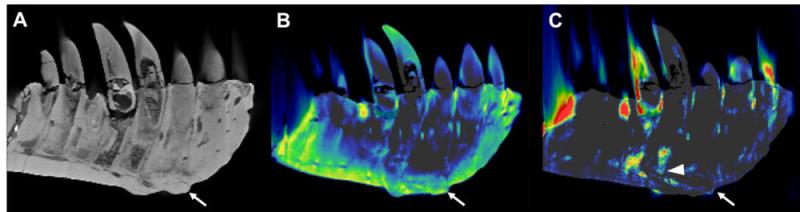 左牙含牙部分的CT重建。(A)侧位重建常规CT图像，显示保存完好的解剖结构，如置换牙齿。图片由RSNA提供