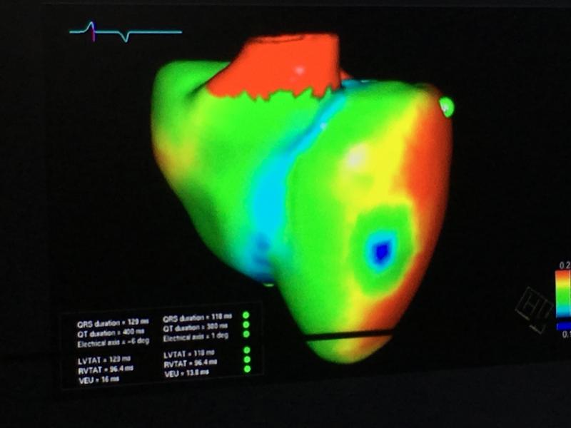 这是西门子公司在2019年HIMSS上发布的一项名为“数字双胞胎心脏”的酷炫新技术。这项正在进行中的研究技术创造了一个数字器官，它具有与患者真正心脏相同的电生理特征，由患者的心电图、核磁共振扫描和其他数据创建。它的主要目的是优化心脏再同步化治疗(CRT)导线放置。CRT目前有30%的无响应率，这主要是由于导线的放置。