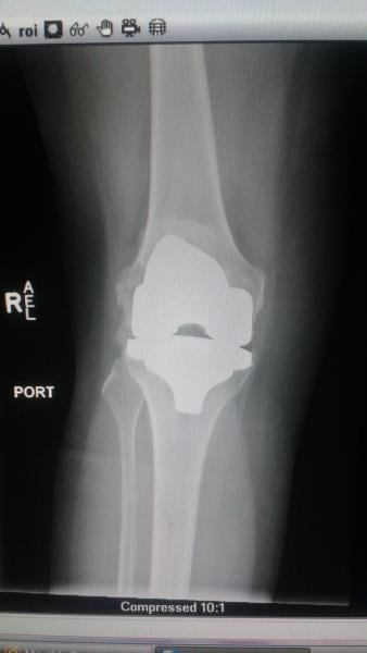 ED x光片显示的玛丽莲·福内尔的膝关节置换。