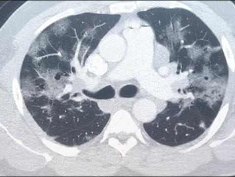 冠状病毒在x光、CT和医学成像上是什么样子的?COVID-19的放射学表现。一例COVID-19肺炎的胸部CT扫描。COVID表现为肺部的白色磨砂玻璃不透明。正常的肺部在CT上应该是黑色的。# COVID # COVID19 #冠状病毒