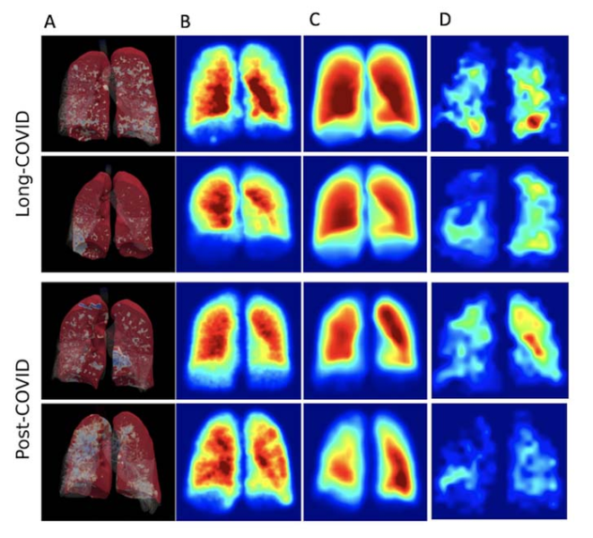 未住院的COVID-19患者和住院后的COVID-19患者的全尺寸气道网络建模分析(FAN) (A)、FAN建模(B)和超偏振氙气成像(C, D)的3D渲染。