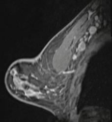 41岁女性，首次接种COVID-19疫苗15天后接受高危筛查乳腺MRI检查。 Sagittal T1-weighted fat-saturated contrast-enhanced MRI shows extensive unilateral left level I-II axillary adenopathy. BI-RADS 3 was assigned.