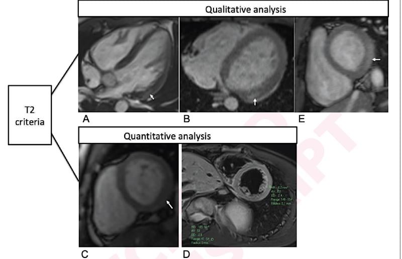 近期接种COVID-19 mRNA引起的心肌炎的基于心肌MRI t2的定性和定量标准定性标准为局灶性心肌水肿，16岁男性(A)和17岁男性(B)在4腔室预对比SSFP图像(箭头)上显示。定量标准包括T2参数映射和心肌信号强度比定量。T2源图像显示左心室基底下壁(箭头)局灶性心外膜下水肿