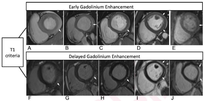 基于心脏MRI t1的近期COVID-19 mRNA烧蚀患者心肌炎标准在(A) 16岁男性，(B) 17岁男性，(C) 16岁男性，(D) 19岁男性的早期造影后短轴SSFP图像上观察到早期钆增强(EGE)与造影前SSFP序列(未显示)相比，在(E) 17岁男性的早期造影后短轴灌注图像上(箭头，A-E)。所有5例患者(F, G, c)均出现晚期钆增强(LGE)(箭头)。