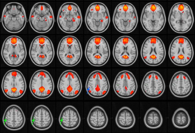 大脑的核磁共振图像。由RSNA