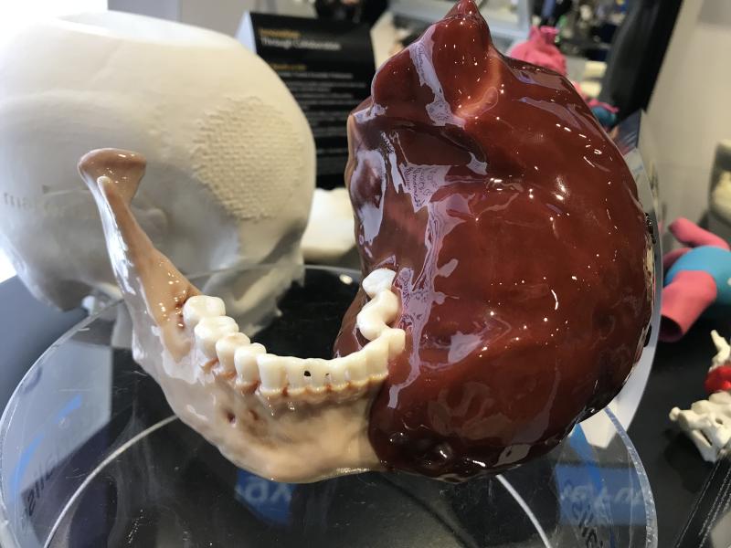 Materialise公司将逼真的3D打印肿瘤植入患者颌骨的例子。该供应商的软件是fda批准的，可用于打印CT或MRI研究的解剖结构，其大小与患者的实际解剖结构完全相同。这可以用于计划和实践复杂的外科或介入程序，模型可以在程序中帮助导航。