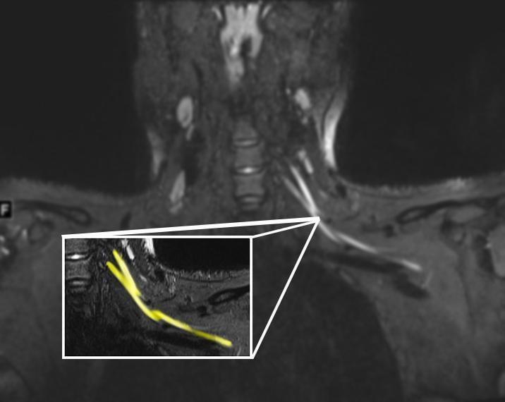 一个20岁出头的病人的磁共振图像显示颈部左臂丛神经损伤(黄色突出)。患者在从COVID-19呼吸道疾病恢复后出现左臂无力和疼痛，这促使他们去看初级保健医生。根据核磁共振检查结果，患者被转到COVID-19神经病学诊所进行治疗。图片由西北大学提供#COVID19 # covid# SARSCoV2